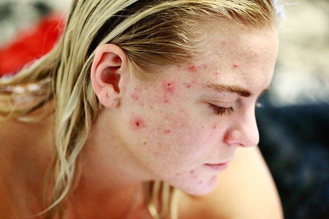 Pimples on Head के बार-बार निकलने का क्या कारण है।